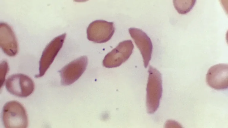 Sickle cell gene therapies offer new hope, accessing them is hard